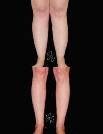 Liposuzione gambe foto prima e dopo