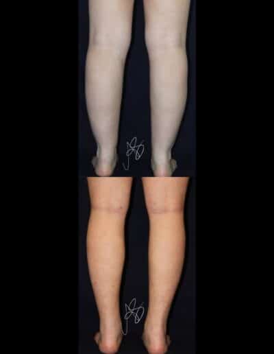 Foto Liposuzione gambe prima e dopo l'intervento