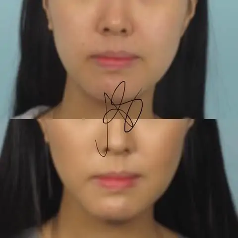 bichectomia i risultati del dottor sapuppo