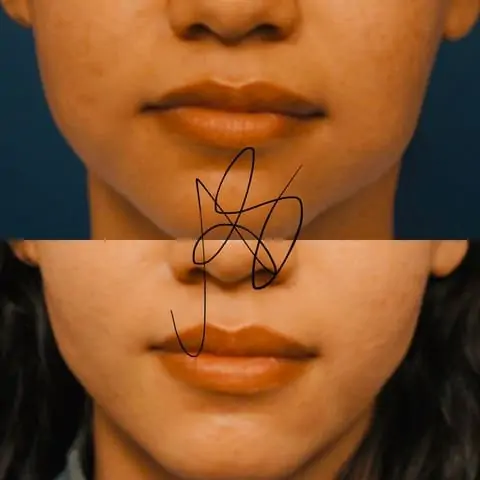 bichectomia prima e dopo l'operazione