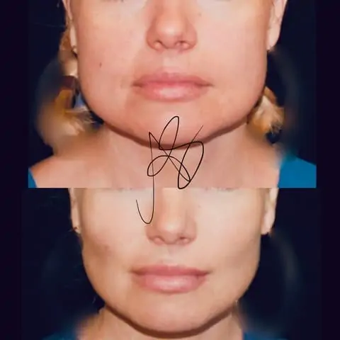 intervento di bichectomia eseguito dal dottor angelo sapuppo