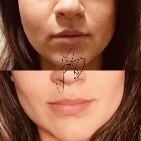 intervento di bichectomia i risultati