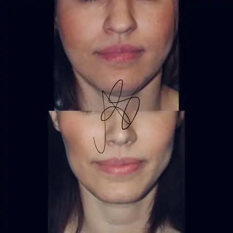 risultati bichectomia: prima e dopo