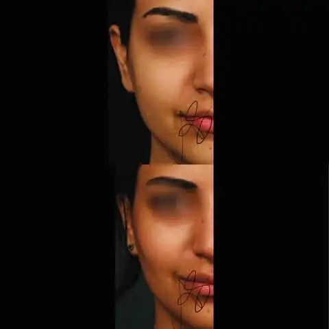 Risultati della bichectomia